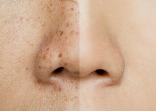 Freckles/Dark Spots Removal
