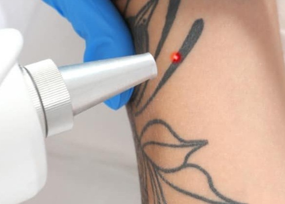 Tattoo Removal