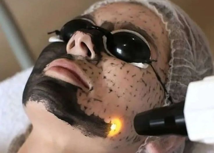 Hollywood Carbon Peel Facial