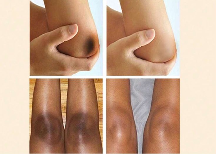 Elbow/Knee Laser Whitening