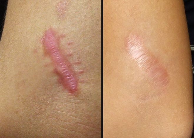 Scars Removal